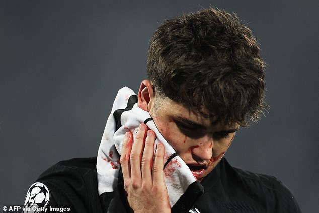 The Spanish centre back required 10 stitches after taking a boot to the face in November